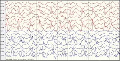 Clinical Attributes and Electroencephalogram Analysis of Patients With Varying Alpers’ Syndrome Genotypes